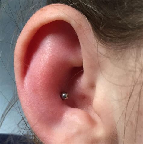 cartilage piercing blister|swollen bump around piercing cartilage.